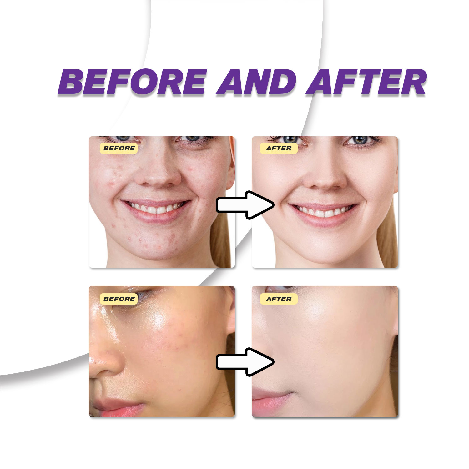 Milde Azelainsäure-Creme verbe – Azelaic Acid Cream Bewertung und Preis