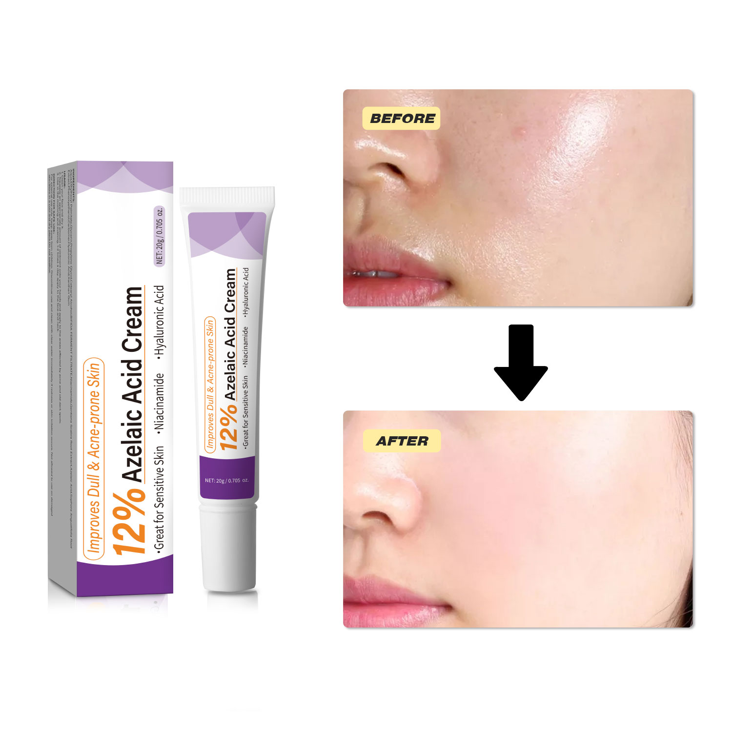 Milde Azelainsäure-Creme verbe – Azelaic Acid Cream Bewertung und Preis